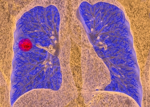 CT scan with lung cancer marked with red